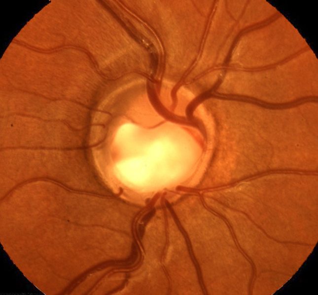 glaucoma-Oftalmologia Valldeperas