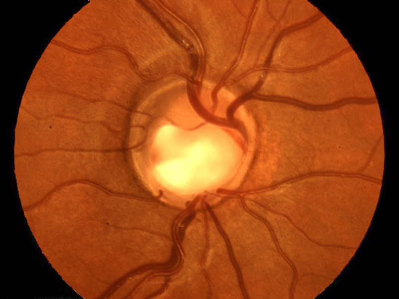 glaucoma-Oftalmologia Valldeperas