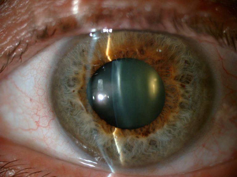 Oftalmologia Valldeperas Cataracta